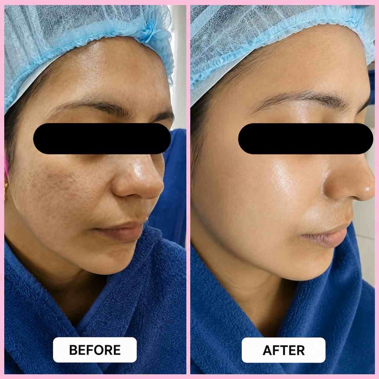 Acne Scar Treatment - After 4 Months